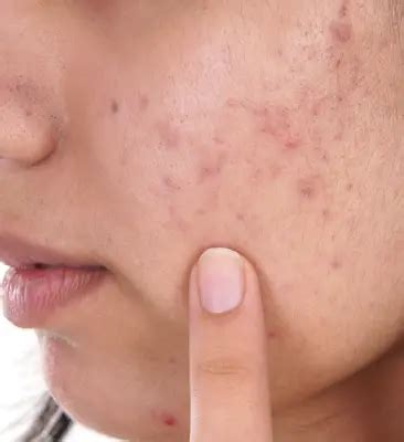 Diagnosis And Treatment Of Acne Scars | Schweiger Dermatology Group