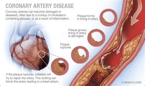 Coronary Artery Disease Symptoms