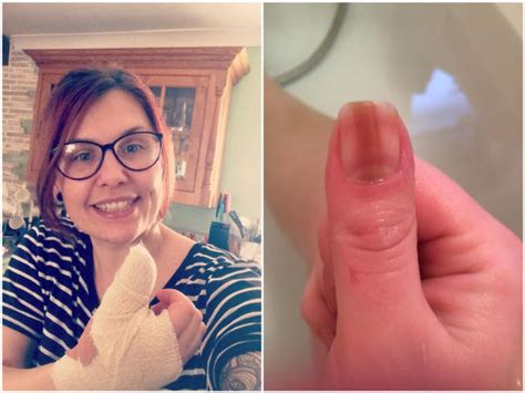 Line on woman's fingernail was sign of skin cancer