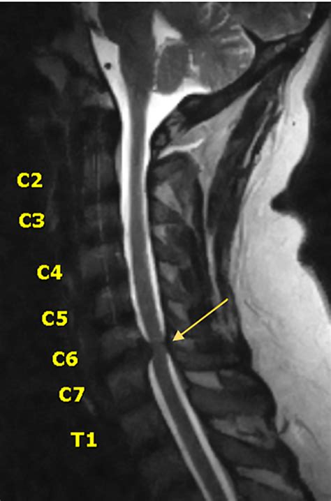 Cervical Spine Mri Comparison