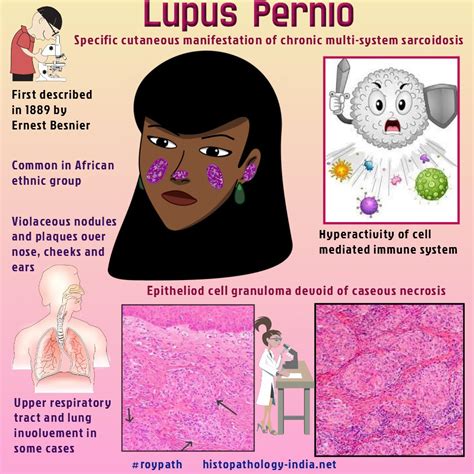 Lupus Pernio Pictures