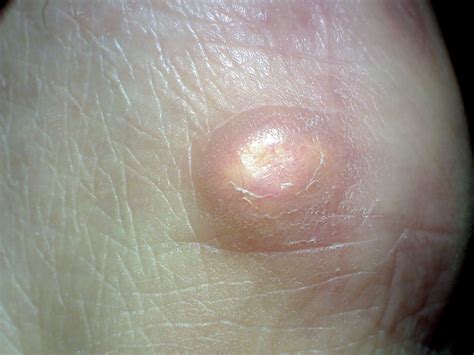 Boil vs. Cyst: Identification and Treatments