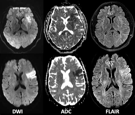 Ischemic Stroke Mri