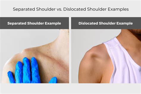 Separated Shoulder vs. Dislocated Shoulder | AOS