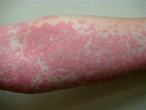 Allergy to Mold - Symptoms, Mold Allergy Rash, Test & Treatment