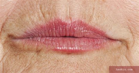 Causes Of Upper Lip Wrinkles and Best Treatments