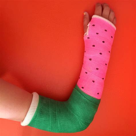 Broken Arm Cast Colors