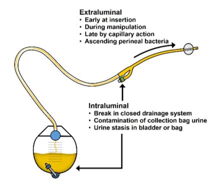 Urinary Catheter Drainage Systems - Best Drain Photos Primagem.Org