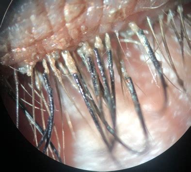 Diagnosing Demodex | The Dry Eye Treatment Center