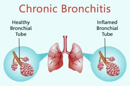 What Causes Chronic Bronchitis & Why It Gets Worse at Night