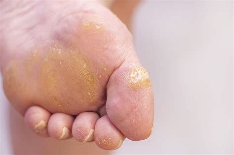 Warts on Your Feet? Symptoms & Causes of Plantar Warts - Foot and Ankle ...