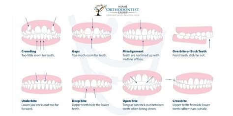 Types Of Bite Problems That Requires Braces - Miami Orthodontist Group