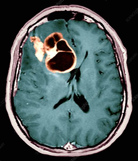 Brain cancer, MRI scan - Stock Image - M134/0469 - Science Photo Library