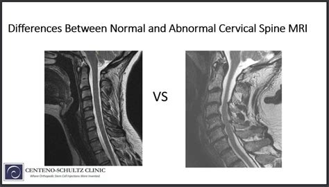 How to read mri images of lumbar spine - drysenturin