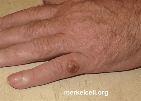 Symptoms of Merkel Cell Carcinoma