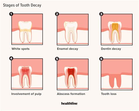 Tooth Decay Process