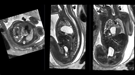 MRI scans more precisely define and detect some abnormalities in unborn ...