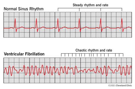 Polymorphic Ventricular Tachycardia Ecg