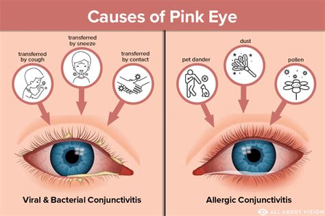 Understanding Conjunctivitis: Causes, Symptoms, And Treatments - Ask ...