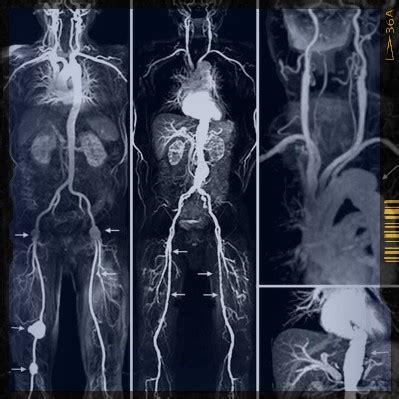 CTA vs MRA - Angiography - RadTechOnDuty