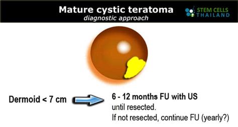 Teratoma Symptoms and Causes | Teratomas and Cancer