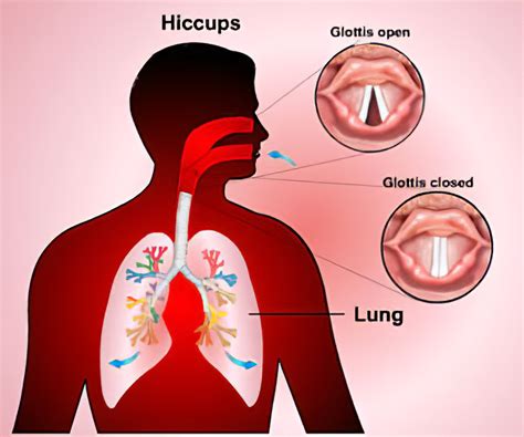 What causes hiccups? | News | Dentagama