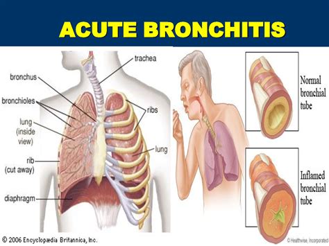 Bronchitis: Types, causes, symptoms & treatments | Global Treatment ...