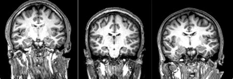 Schizophrenia Brain Scan