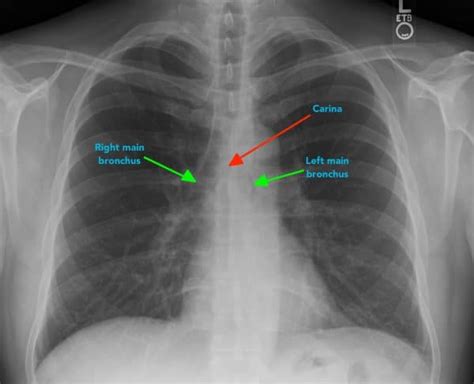 Chest X-ray interpretation - a structured approach