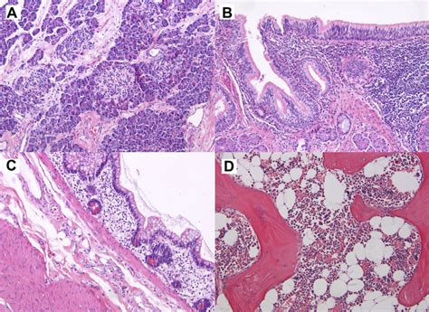 Teratoma Pathology