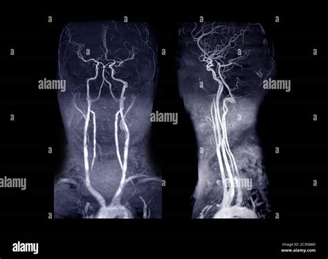 MRA Brain and neck or Magnetic resonance angiography ( MRA ) of ...