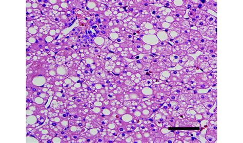 Liver Steatosis | MedicineBTG.com