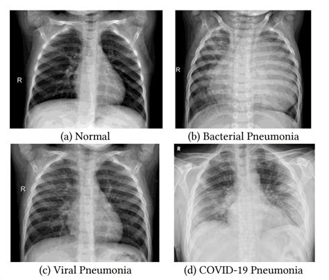 Chest X Ray Bronchitis Vs Pneumonia