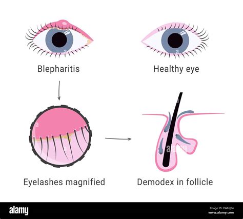 Demodex infection causing blepharitis. Eyelash mites microscope view ...