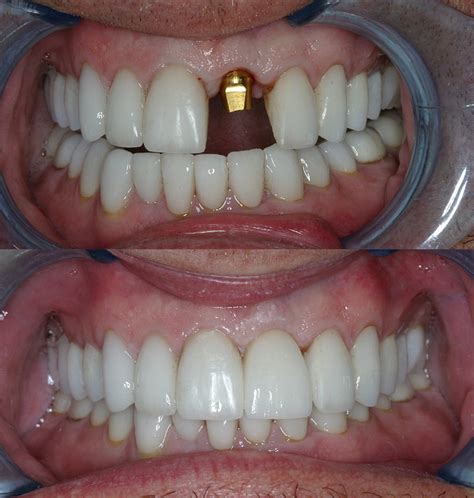 Before & After Implant Retained Crowns - Cosmetic Dentists of Houston ...