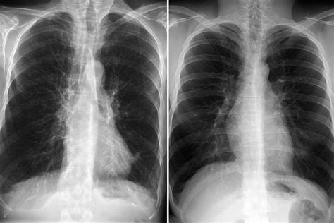 Emphysema Chest X Ray