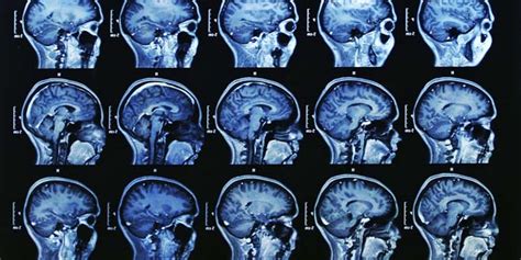 MRI vs MRA - Difference and Comparison | Diffen