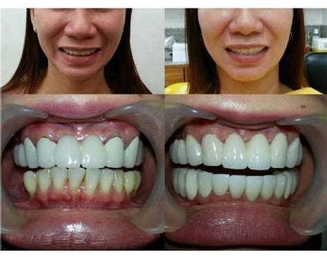 Facelift Dentures Before And After (24) » Facelift: Info, Prices ...