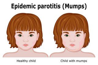 Mumps symptoms - HSE.ie