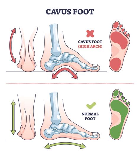 Cavovarus Reconstruction/High Arch Surgery - Perth Orthopaedic ...