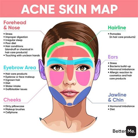 Proskin Aesthetics on Instagram: "THIS IS WHAT ACNE SAYS ABOUT YOUR ...