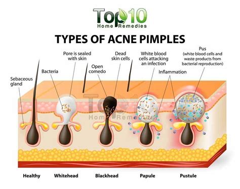 Acne and also Pimples Remedies. All-natural methods to get rid of as ...