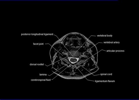 MRI spine anatomy | free MRI axial cervical spine anatomy | Mri ...