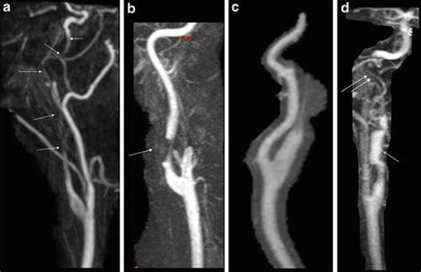 Vertebral Artery Dissection Mri