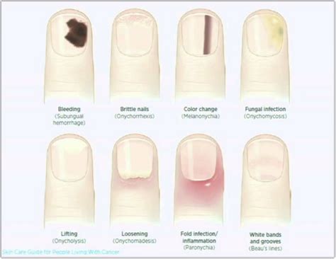 Nail Cancer Pictures - Nails Magazine