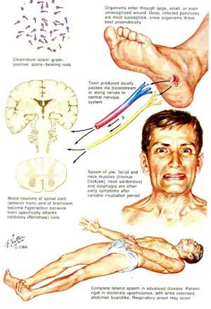 Tetanus | Media of human drug-disease information