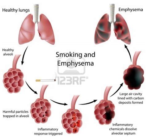 Emphysema (COPD). Causes, symptoms, treatment Emphysema (COPD)