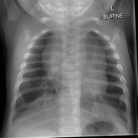 Chest X Ray Pneumonia Vs Bronchitis