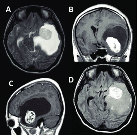 Brain Lesions Mri