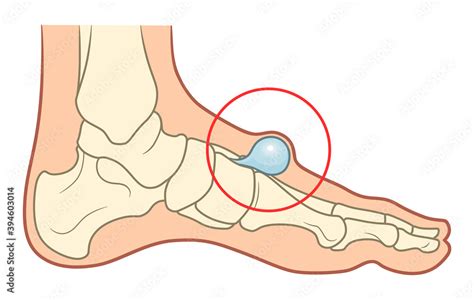 Ganglion foot cyst illustration Stock Vector | Adobe Stock